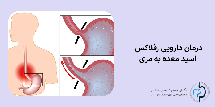 درمان دارویی رفلاکس اسید معده به مری