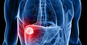 علائم و درمان عفونت یا آبسه کبدی