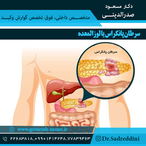 سرطان پانکراس یا لوزالمعده