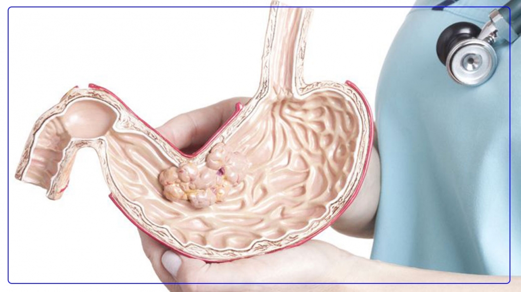 بیماری معده