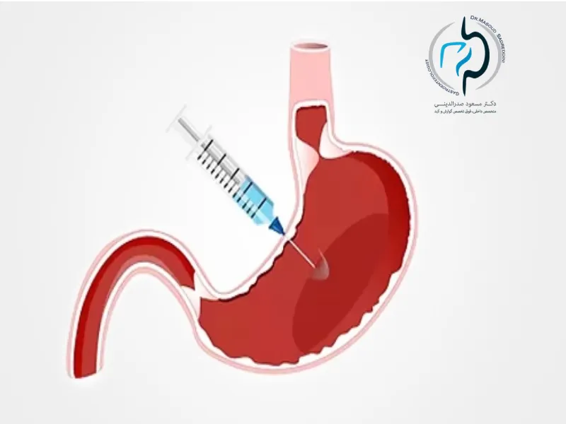 تزریق بوتاکس معده