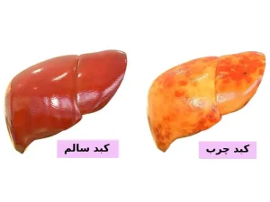 دارو برای درمان کبد چرب