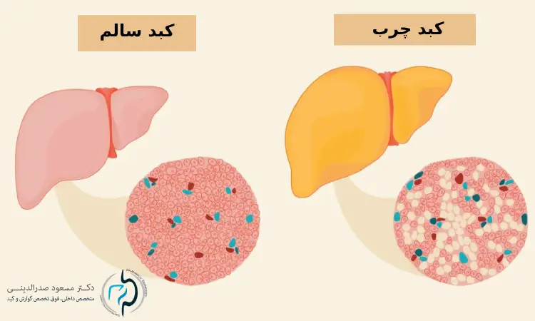 بهترین دارو برای درمان کبد چرب چیست؟