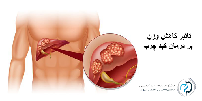 چگونگی تأثیر کاهش وزن بر کاهش چربی کبد