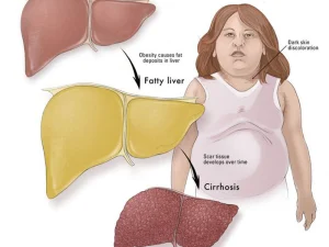 کبد چرب در کودکان