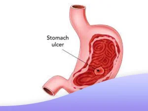 تفاوت زخم معده و زخم اثنی عشر