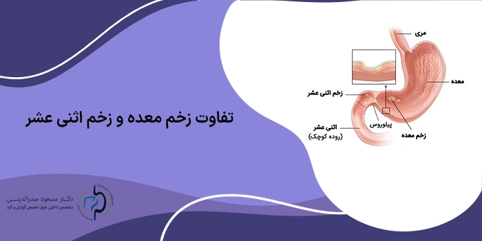 تفاوت زخم معده و زخم اثنی عشر