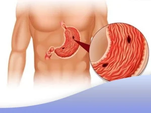 رژیم غذایی زخم معده