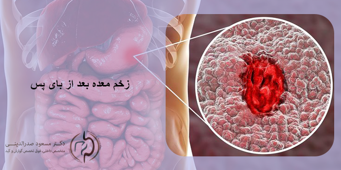 زخم معده بعد از بای پس