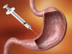 ورزش بعد از بوتاکس معده