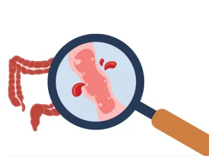 خونریزی روده بزرگ