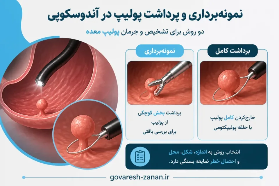 نمونهبرداری و برداشت پولیپ در آندوسکوپی — برداشت پولیپ معده در جریان آندوسکوپی