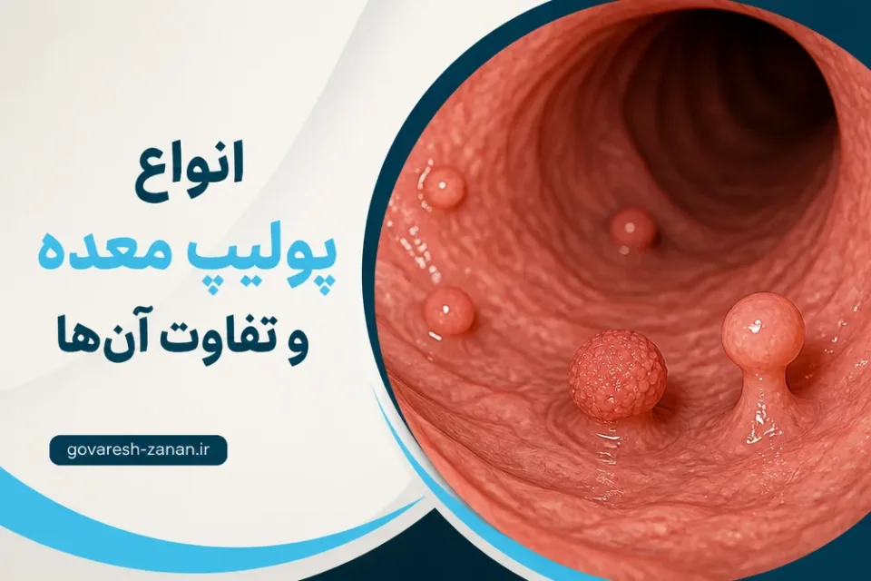 انواع پولیپ معده و تفاوت آنها — نمای آموزشی انواع پولیپ معده در آندوسکوپی