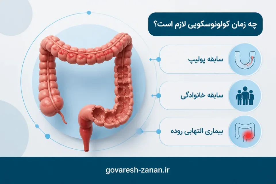 بیماریهای التهابی روده — عوامل خطر شامل پولیپ قبلی، سابقه خانوادگی و بیماری التهابی روده که پیگیری کولونوسکوپی را تغییر میدهند
